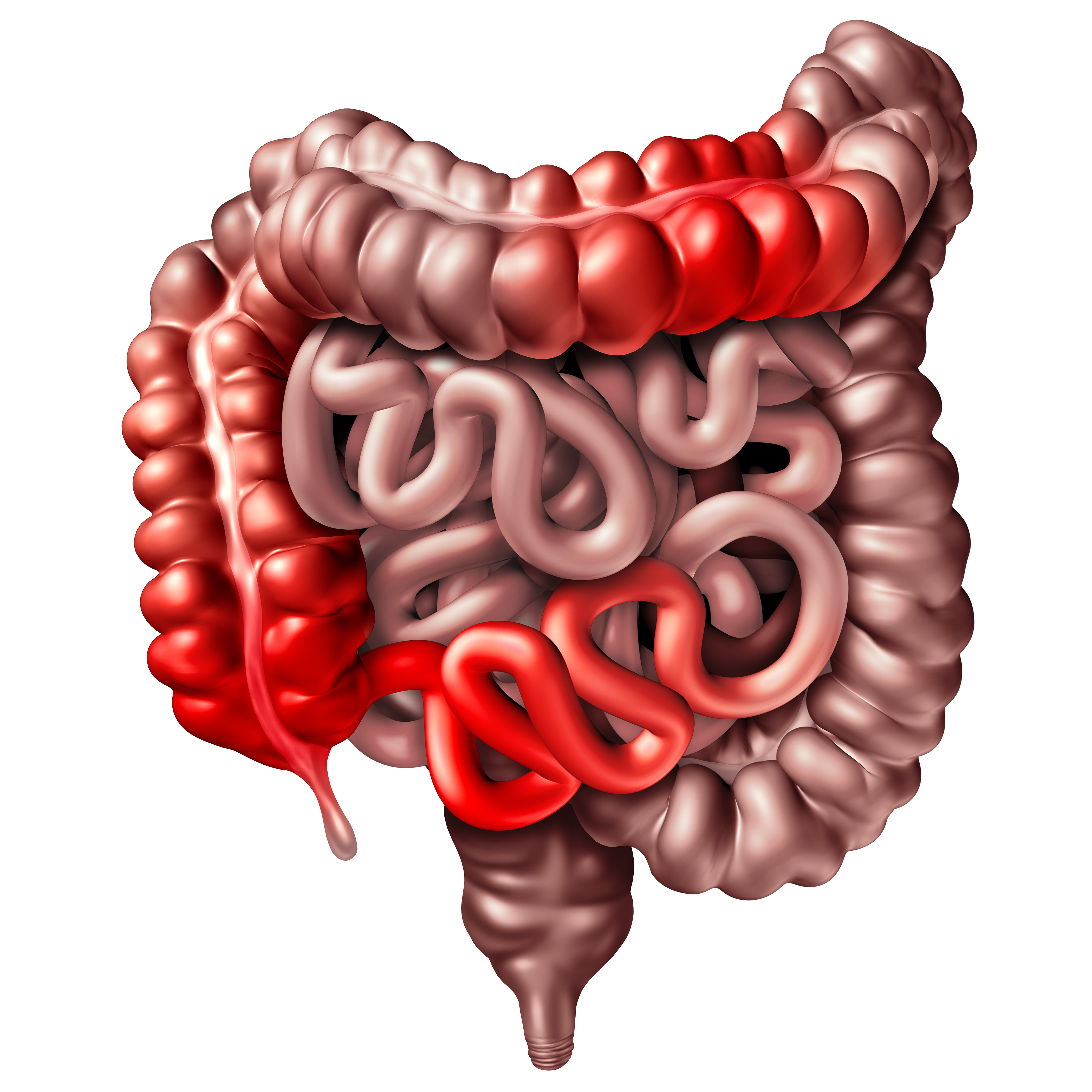 Ziekte van Crohn skippatroon